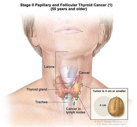 Thyroid Cancer Staging | RMCC