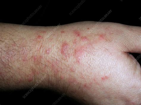 Dermatitis herpetiformis - Stock Image - C056/5418 - Science Photo Library