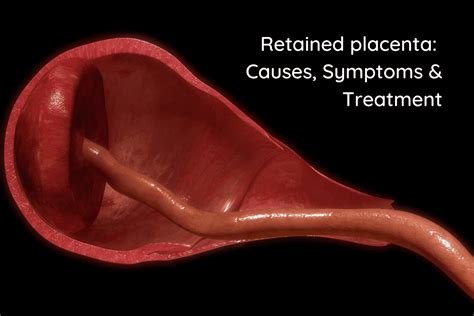 Retained Placenta 3 Weeks After Birth