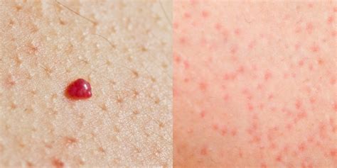 Little Red Spots On Skin Looks Like Blood