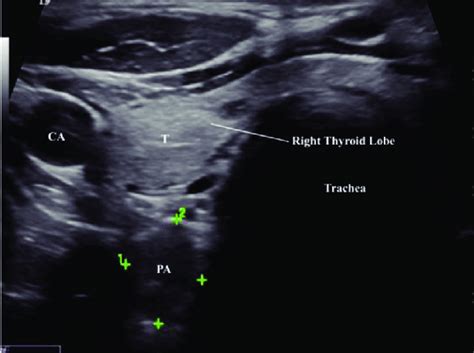 Parathyroid Nodule Ultrasound