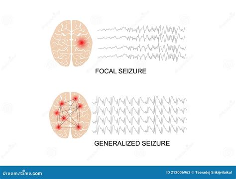 Epilepsy Brain Waves