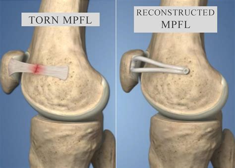 Patella kneecap dislocation, Patella kneecap pain | Dr.Raj Kanna