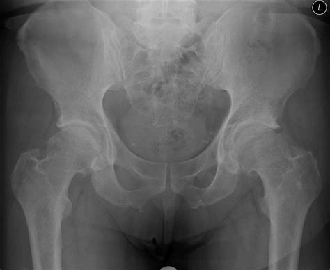 SurfaceHippy | A Normal Joint X-Ray Image | Old, Surgery, Hip, Left