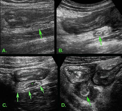 Terminal Ileum Ultrasound