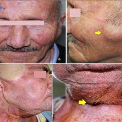 The patient with a diagnosis of squamous cell carcinoma of skin at ...