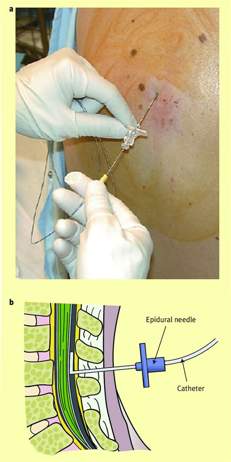 4916 Epidural Catheter