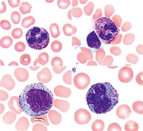 Neutrophils and monocytes with increased azurophilic granules resembling toxic changes in ...