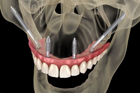 Zygomatic Implants | San Antonio, TX | Preferred Dental Center