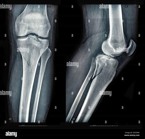 Xray images showing real fracture of broken leg bone under the knee ...