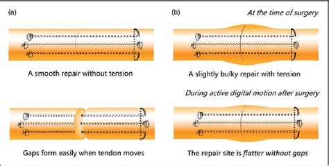 Figure 1 from Recent evolutions in flexor tendon repairs and ...