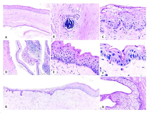 Odontogenic Keratocyst Histology