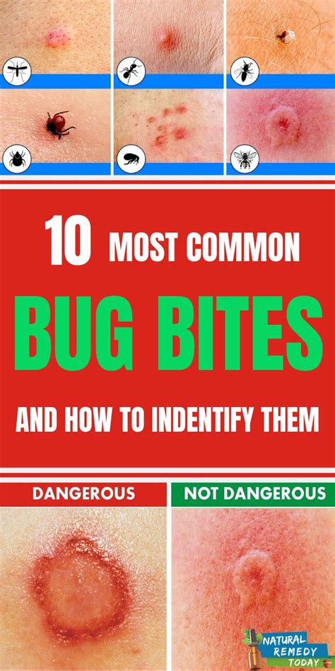 10 Bug Bites Anyone Should Be Able to Identify in 2020 | Bug bites ...