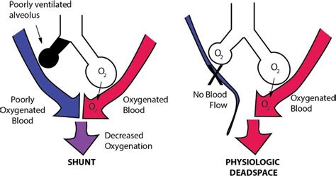 physiological shunt - Google Search | Pulmonary shunt, Medical ...