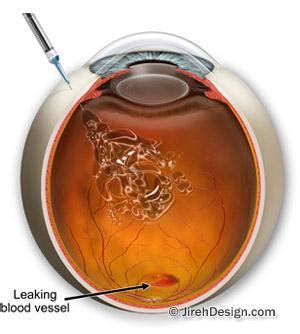 Eylea for macular degeneration and retinal vein occlusion