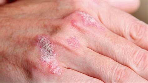 ¿Qué es la psoriasis? – Laboratorios Bagó