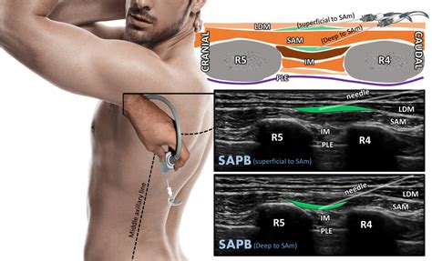 Húmedo Puede soportar Culpa serratus anterior nerve block absorción Animado Cerco