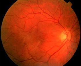 Epiretinal Membrane (Macular Pucker) Surgery & Recovery | Eye Center of ...