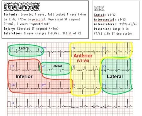 Ekg Interpretation Made Easy , Ekg | Icu nursing, Cardiac nursing ...