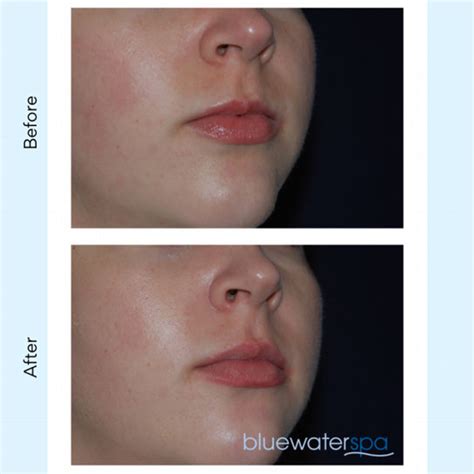 Lip Flip Botox Before And After Photos - Infoupdate.org