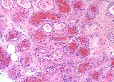 The normal histology of the nasal turbinate includes a dense network of large and irregularly ...