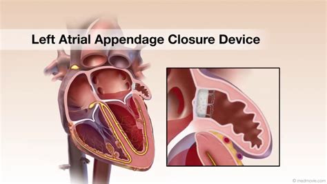 Heart Failure – Medmovie.com