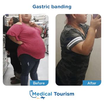 Licensed Doctors For Gastric Band Surgery | Medical Tourism Mexico