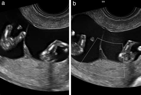 Lambda And T Sign In Twin Pregnancy : Twin peak sign or lambda sign