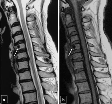 Cervical Spinal Cord Lesion MRI