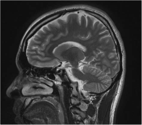 Cerebellum Sagittal Section