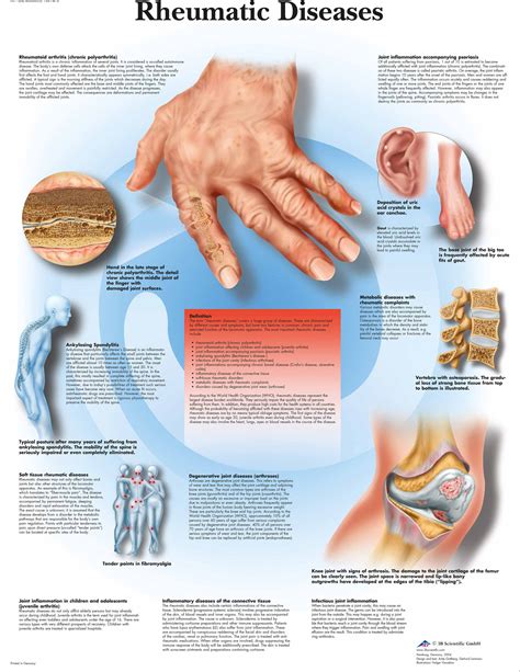 Rheumatic Diseases