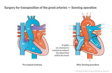 Cardiology : Transposition of the Great Arteries