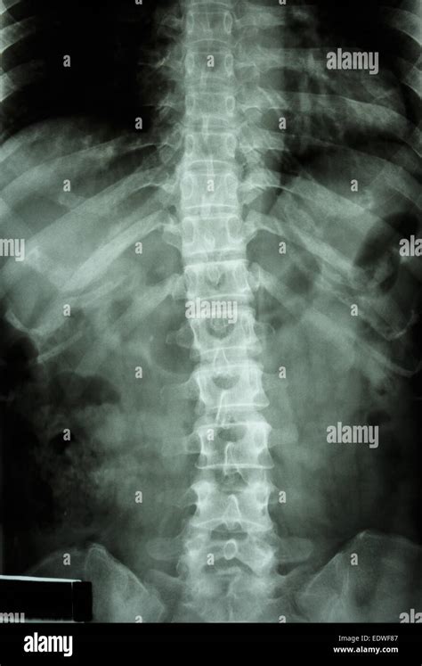 Lumbar Spine X Ray