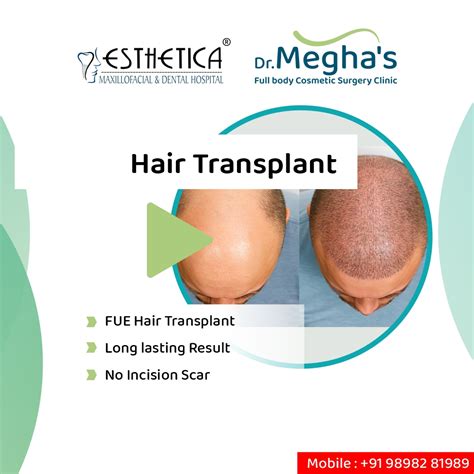 Hair Transplant, FUE Technique, Hair Loss, Mesotherapy, PRP- Esthetica