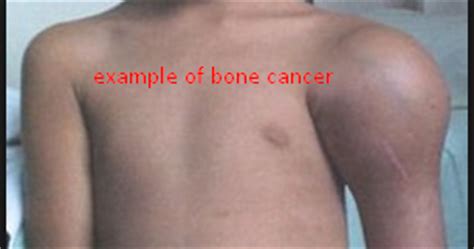 Causes Of Bone Cancer