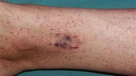 Petechiae: Symptoms, Causes, Sizes and Treatments | Health Digest