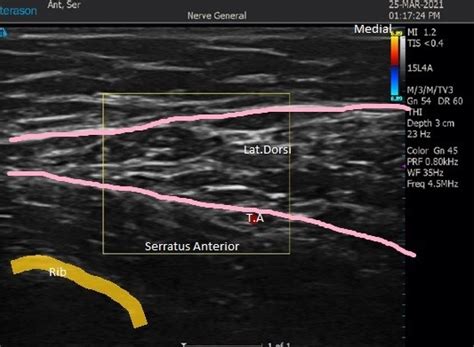 Ultrasound Guided Serratus Anterior Plane Block – RCEMLearning India