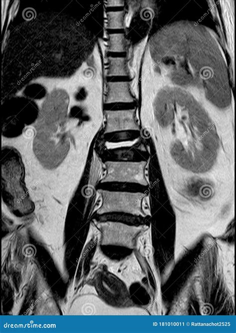 Burst Fracture At Lumbar Spine Stock Image | CartoonDealer.com #40239001