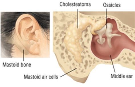 Lump Behind Ear - Hard, Painful, small, swollen, on ear lobe