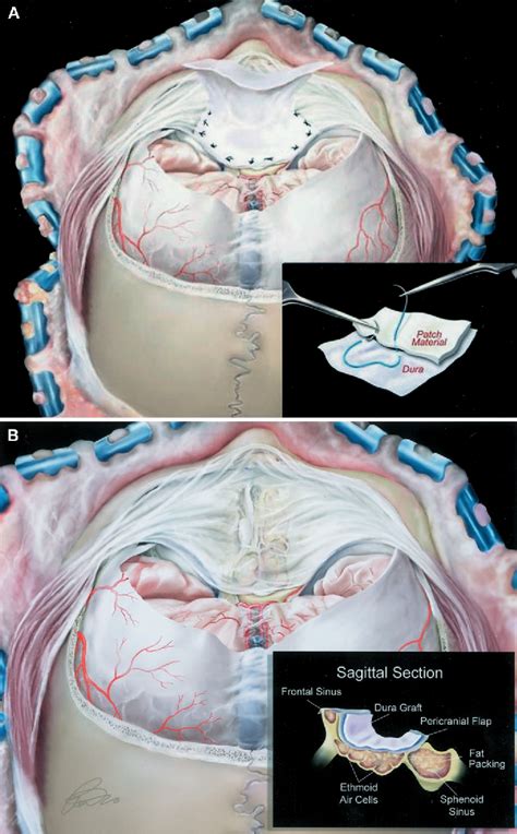 Olfactory Groove Meningioma | Semantic Scholar