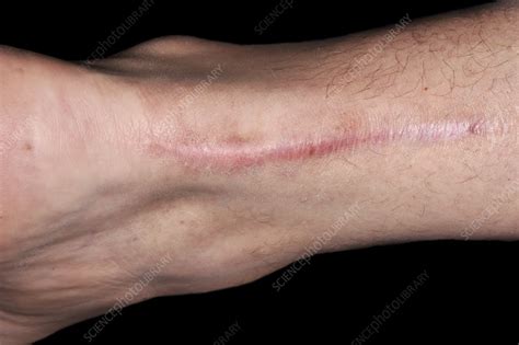 Scar from Achilles tendon surgery - Stock Image - C045/6707 - Science Photo Library