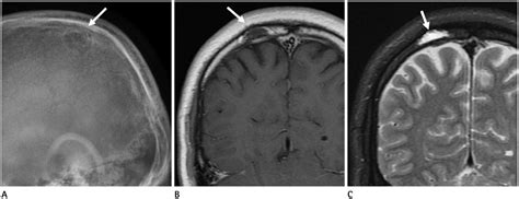 Imaging Findings of Various Calvarial Bone Lesions with a Focus on ...