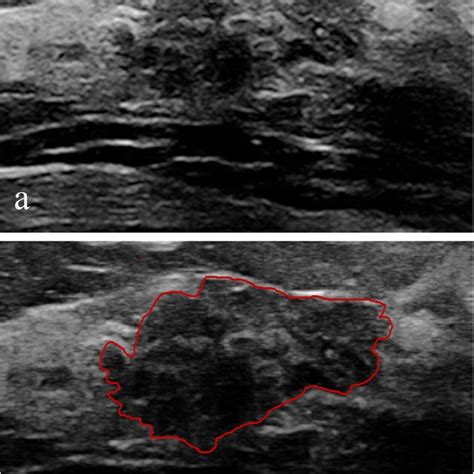 Intraductal carcinoma in situ classified as BI-RADS 4A. a Ultrasound... | Download Scientific ...