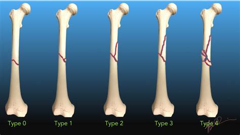 Distal Femur Fracture Classification