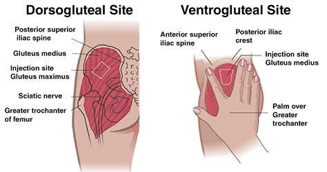 Dorso Vs Ventro - Which Glute Injection Is Best For TRT? - The TRT Hub