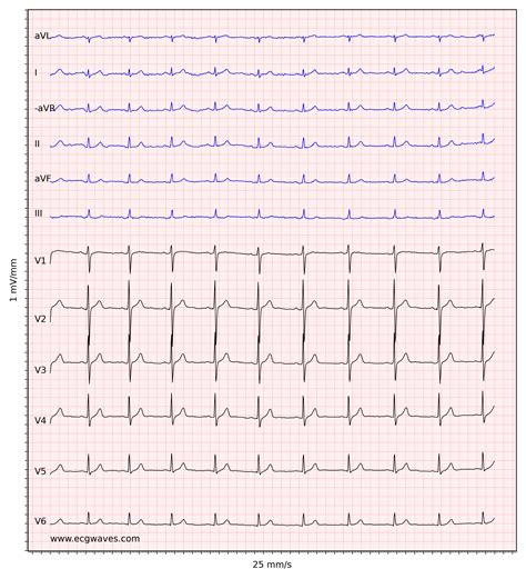 ECG interpretation: Characteristics of the normal ECG (P-wave, QRS ...