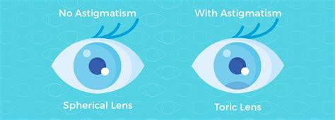 Toric lenses vs regular lenses | doctorvisit