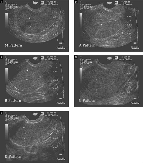 Endometrial Phases Ultrasound