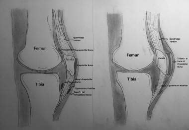 Popliteal Fossa Bursitis