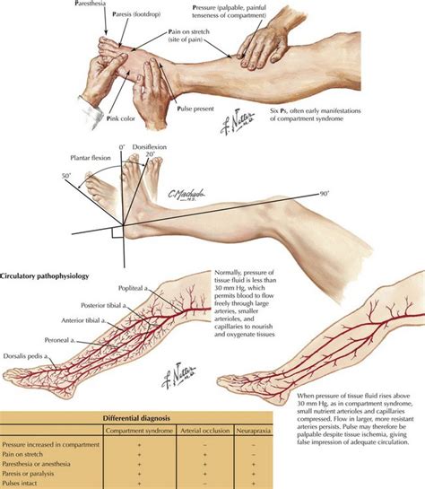 Compartment Syndrome Toe